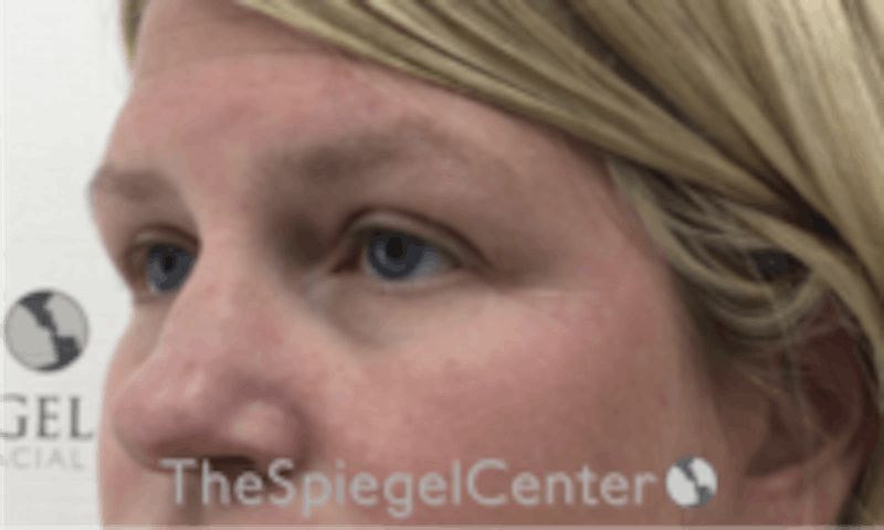 Tear Trough / Under Eye Fillers Before & After Gallery - Patient 241672 - Image 3