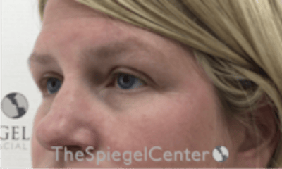 Tear Trough / Under Eye Fillers Before & After Gallery - Patient 241672 - Image 3