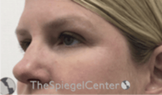 Tear Trough / Under Eye Fillers Before & After Gallery - Patient 241672 - Image 4