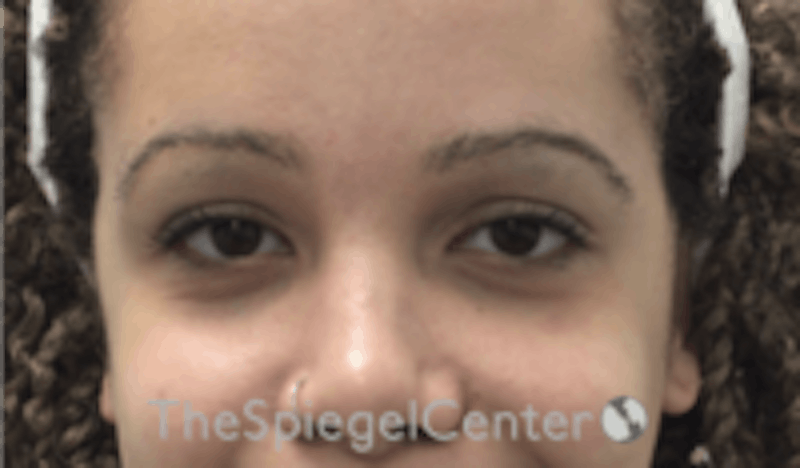 Tear Trough / Under Eye Fillers Before & After Gallery - Patient 202189 - Image 1