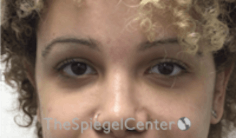 Tear Trough / Under Eye Fillers Before & After Gallery - Patient 202189 - Image 2