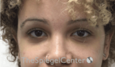 Tear Trough / Under Eye Fillers Before & After Gallery - Patient 202189 - Image 2