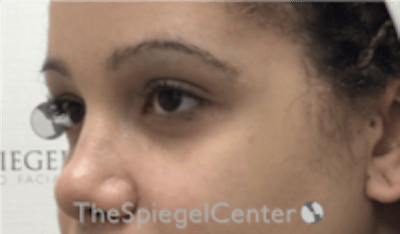 Tear Trough / Under Eye Fillers Before & After Gallery - Patient 202189 - Image 3