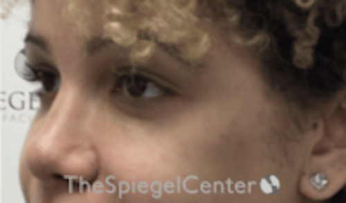Tear Trough / Under Eye Fillers Before & After Gallery - Patient 202189 - Image 4