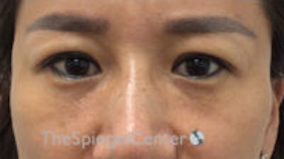 Tear Trough / Under Eye Fillers Before & After Gallery - Patient 265093 - Image 2