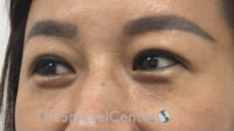 Tear Trough / Under Eye Fillers Before & After Gallery - Patient 265093 - Image 3