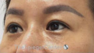 Tear Trough / Under Eye Fillers Before & After Gallery - Patient 265093 - Image 4