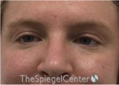 Tear Trough / Under Eye Fillers Before & After Gallery - Patient 210912 - Image 1
