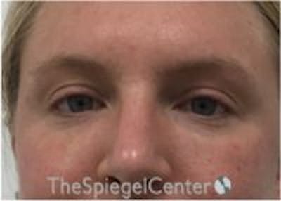 Tear Trough / Under Eye Fillers Before & After Gallery - Patient 210912 - Image 2