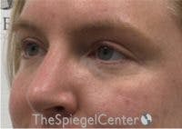 Tear Trough / Under Eye Fillers Before & After Gallery - Patient 210912 - Image 3
