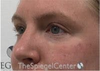 Tear Trough / Under Eye Fillers Before & After Gallery - Patient 210912 - Image 4