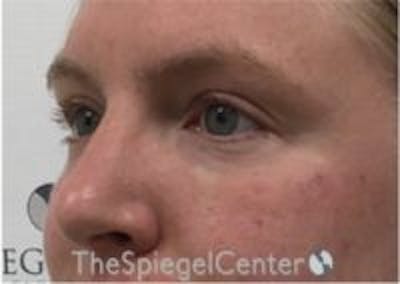 Tear Trough / Under Eye Fillers Before & After Gallery - Patient 210912 - Image 4