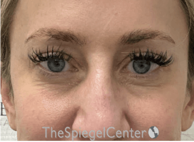 Tear Trough / Under Eye Fillers Before & After Gallery - Patient 356825 - Image 1
