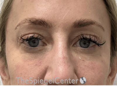 Tear Trough / Under Eye Fillers Before & After Gallery - Patient 356825 - Image 2