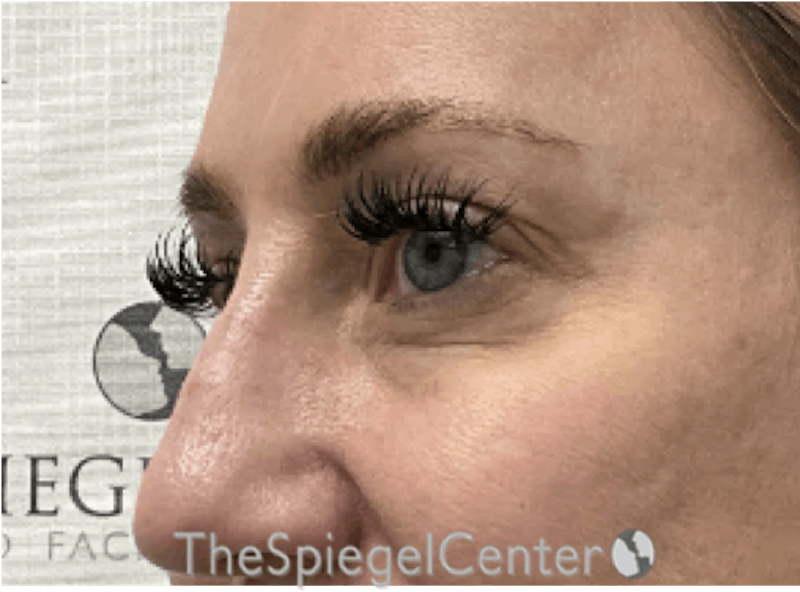 Tear Trough / Under Eye Fillers Before & After Gallery - Patient 356825 - Image 3