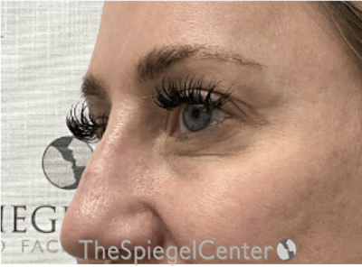 Tear Trough / Under Eye Fillers Before & After Gallery - Patient 356825 - Image 3