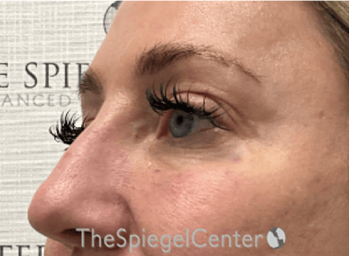 Tear Trough / Under Eye Fillers Before & After Gallery - Patient 356825 - Image 4