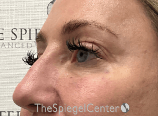 Tear Trough / Under Eye Fillers Before & After Gallery - Patient 356825 - Image 4