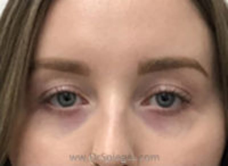 Tear Trough / Under Eye Fillers Before & After Gallery - Patient 304570 - Image 1