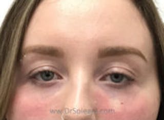 Tear Trough / Under Eye Fillers Before & After Gallery - Patient 304570 - Image 2