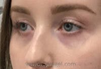 Tear Trough / Under Eye Fillers Before & After Gallery - Patient 304570 - Image 3