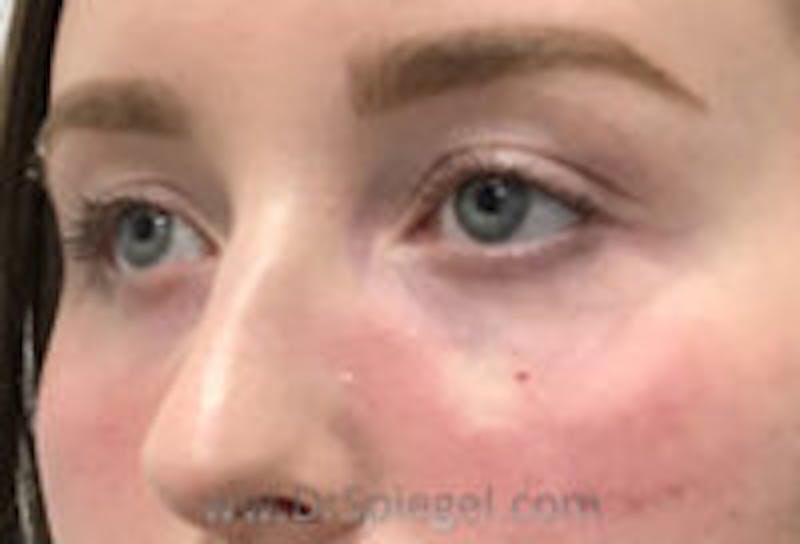 Tear Trough / Under Eye Fillers Before & After Gallery - Patient 304570 - Image 4