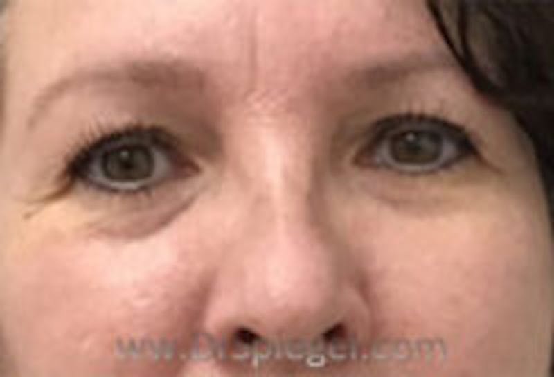 Tear Trough / Under Eye Fillers Before & After Gallery - Patient 100750 - Image 1