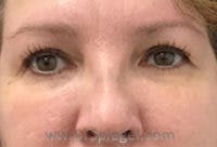 Tear Trough / Under Eye Fillers Before & After Gallery - Patient 100750 - Image 2