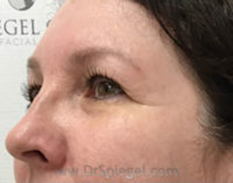 Tear Trough / Under Eye Fillers Before & After Gallery - Patient 100750 - Image 3