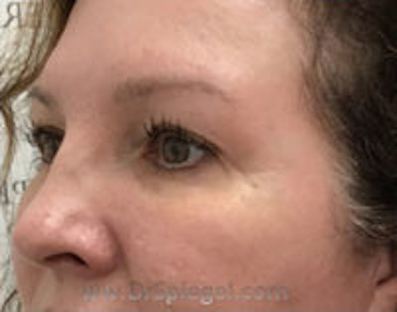 Tear Trough / Under Eye Fillers Before & After Gallery - Patient 100750 - Image 4