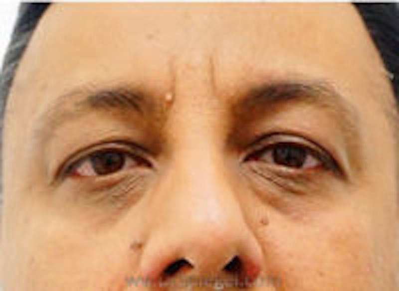 Tear Trough / Under Eye Fillers Before & After Gallery - Patient 358730 - Image 1