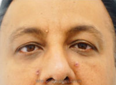Tear Trough / Under Eye Fillers Before & After Gallery - Patient 358730 - Image 2