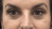 Tear Trough / Under Eye Fillers Before & After Gallery - Patient 155091 - Image 1