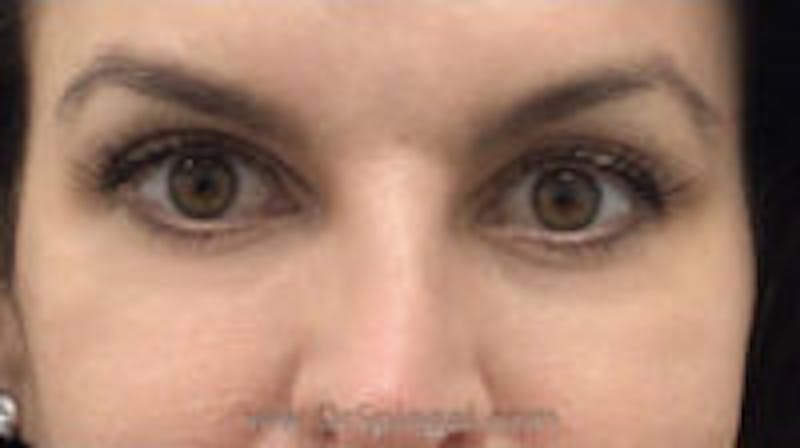 Tear Trough / Under Eye Fillers Before & After Gallery - Patient 155091 - Image 2