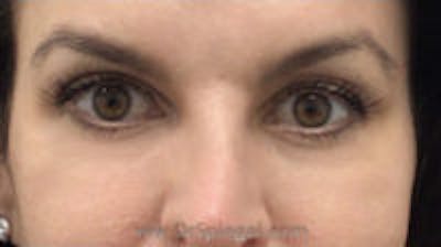 Tear Trough / Under Eye Fillers Before & After Gallery - Patient 155091 - Image 2