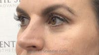 Tear Trough / Under Eye Fillers Before & After Gallery - Patient 155091 - Image 3