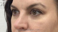 Tear Trough / Under Eye Fillers Before & After Gallery - Patient 155091 - Image 4