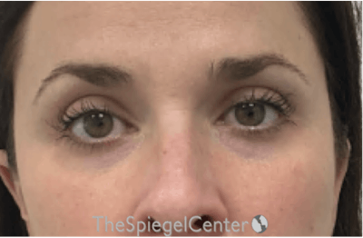 Tear Trough / Under Eye Fillers Before & After Gallery - Patient 284112 - Image 1