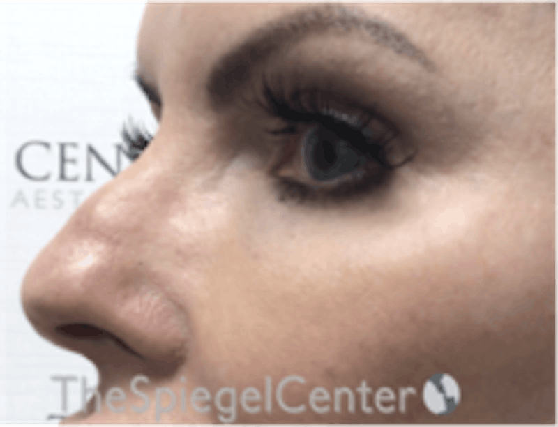 Tear Trough / Under Eye Fillers Before & After Gallery - Patient 250674 - Image 3