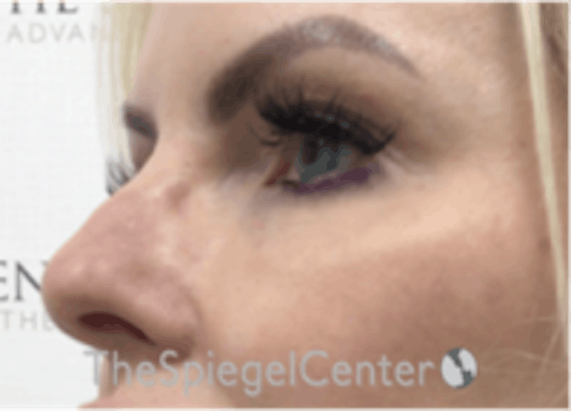 Tear Trough / Under Eye Fillers Before & After Gallery - Patient 250674 - Image 4