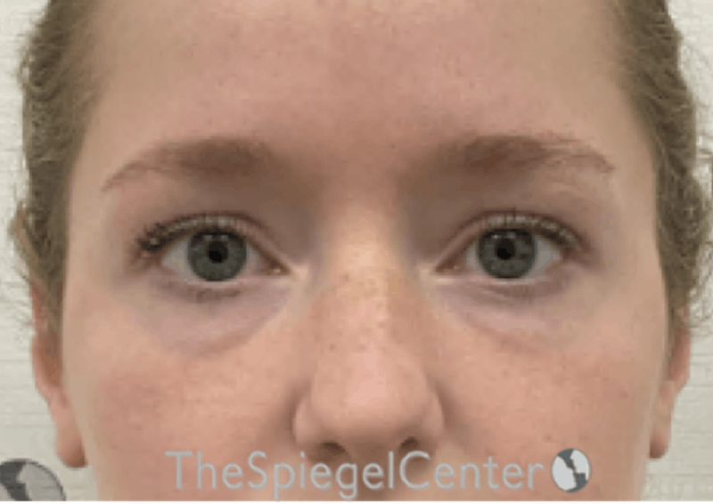 Tear Trough / Under Eye Fillers Before & After Gallery - Patient 352504 - Image 1