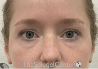 Tear Trough / Under Eye Fillers Before & After Gallery - Patient 352504 - Image 1
