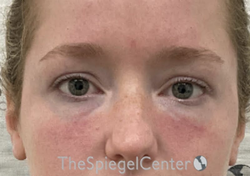 Tear Trough / Under Eye Fillers Before & After Gallery - Patient 352504 - Image 2