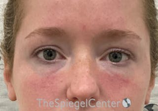 Tear Trough / Under Eye Fillers Before & After Gallery - Patient 352504 - Image 2
