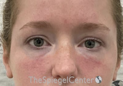 Tear Trough / Under Eye Fillers Before & After Gallery - Patient 352504 - Image 2