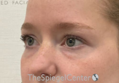 Tear Trough / Under Eye Fillers Before & After Gallery - Patient 352504 - Image 3