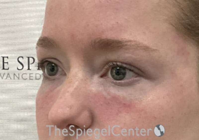 Tear Trough / Under Eye Fillers Before & After Gallery - Patient 352504 - Image 4