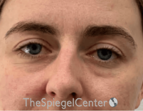 Tear Trough / Under Eye Fillers Before & After Gallery - Patient 200416 - Image 1
