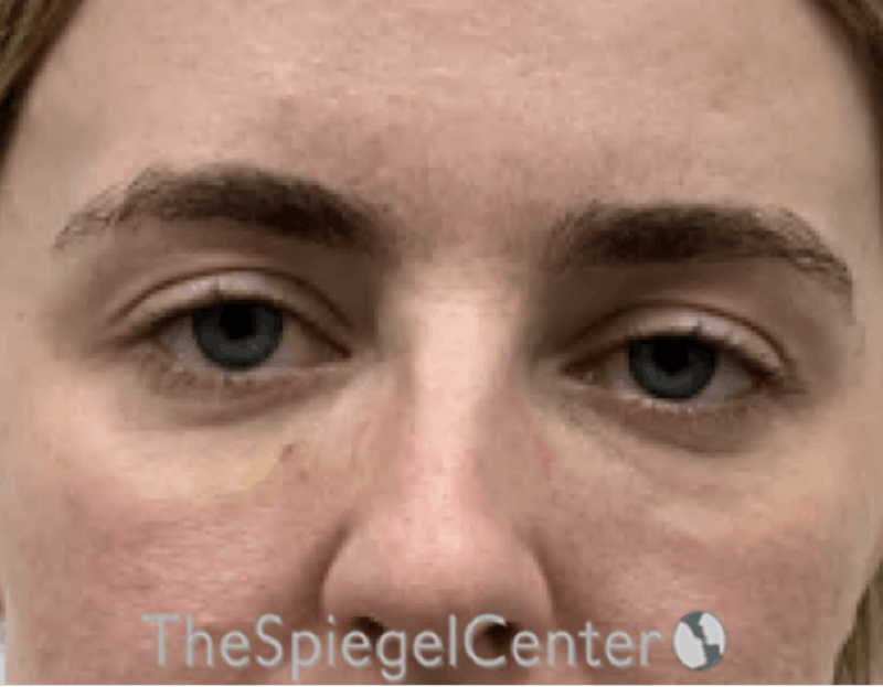 Tear Trough / Under Eye Fillers Before & After Gallery - Patient 200416 - Image 2