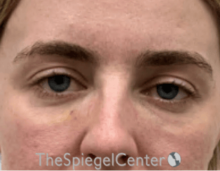 Tear Trough / Under Eye Fillers Before & After Gallery - Patient 200416 - Image 2